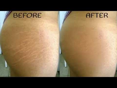 can-you-get-rid-of-stretch-marks